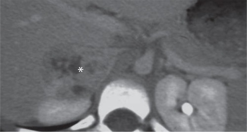 Figure 4 Contrast-enhanced abdominal CT-scan.