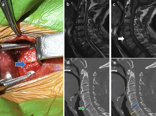 Figure 2 (a) Rupture of the anterior longitudinal ligament was shown in the surgical field (blue arrow). (b) No obvious high signal intensity of prevertebral in T2-weighted phase. (c) On T1-weighted phase of MRI, the interruption of prevertebral low signal intensity at C5/6 (white arrow). (d) The CT showed interruption of prevertebral hyperplastic bone (green arrow) at C5/6. (e) The TOPST of C3 and C6 was 0.68cm and 1.48cm (yellow line), the red dot represents the three points of IDA, and the IDA of C5/6 was 28.14 ° (blue line).