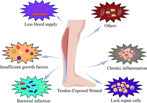 Figure 1. Pathophysiological mechanisms in the pathogenesis of tendon exposed wounds. The mechanisms include bacterial infection, poor vascularization, insufficient growth factors and lack of repair cells.