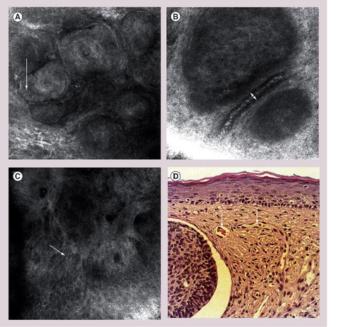 Figure 2. Reflectance confocal microscopy images of basal cell carcinoma.(A) Nests of tumor cells in the dermis, elongated shape of cells and nuclei (arrow), dark spaces in between tumor nodules and surrounding collagen correspond to clefts on histopathology. (B) Large, dilated blood vessels adjacent to dermal tumor nest (arrow) with highly reflective white cells in the center of the vessel correspond to erythrocytes. (C) Polarization of cells (arrow). (D) Representative hematoxylin and eosin histology of basal cell carcinoma with nests of basaloid tumor cells, clefting and blood vessel dilatation (arrow).