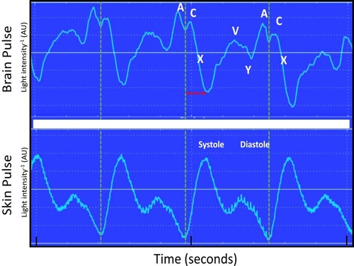 Figure 1 Simultaneous recording of the brain and conventional skin pulse oximetry waveforms in a single normal sheep brain. The dashed lines represent the start of the skin pulse. The brain and skin pulses were distinct, with the brain pulse demonstrating a waveform similar in shape and timing to a central venous pressure waveform, with A, C, X, V and Y waves, whereas the skin pulse demonstrated a waveform similar in shape and timing to an arterial pressure waveform. In addition, the start of the brain pulse was delayed relative to the skin pulse, by around 100 ms (arrow) and the peak of the pulse was at the end of diastole.