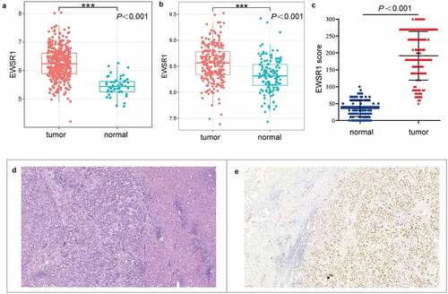 Figure 1. EWSR1 expression between tumor and non-tumor liver tissues in HCC patients in TCGA (a) and GEO (b) datasets, and our cohort (c). Hematoxylin and eosin staining of HCC (left) and paratumoral, healthy (right) tissues (d). Positive immunohistochemical staining of EWSR1 in HCC (right), negative in paratumoral normal (left) tissue (e). Scale: 100 μm. Abbreviations: GEO, Gene Expression Omnibus; HCC, hepatocellular carcinoma; TCGA, The Cancer Genome Atlas