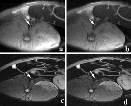 Figure 1. Benefit from shorter acquisition time, GRAPPA PDW images with 3NSA (a.) and T2 W images with 3NSA has comparable or better image quality than standard TSE PDW (b) and T2 W image (d). Arrows indicate the abdominal aorta of the WHHL rabbit.