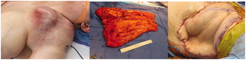 Figure 2. Case II pre-operative mass, intra-operative fasciocutaneous flap and post-operative result.