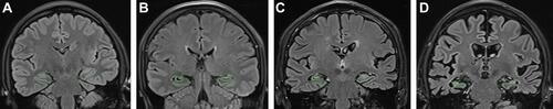 Figure 2 Changes in hippocampal morphology as determined using MRI. (A) Normal hippocampal morphology. (B) Mild hippocampal atrophy (MMSE = 25). (C) Moderate hippocampal atrophy (MMSE = 16). (D) Severe hippocampal atrophy (MMSE = 7).