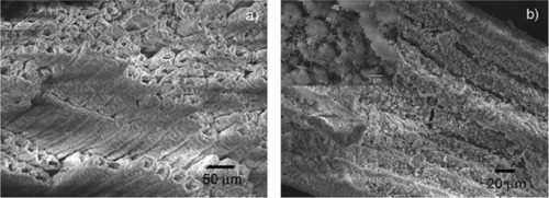 Figure 8 Detailed scanning electron microscopy images of pinewood-derived hydroxyapatite. A) Microstructure of wood-derived parallel fastened hydroxyapatite microtubes. B) Typical needlelike HA nuclei grown on the microtube surface; the inset shows a higher magnification of B. Copyright (c) 2009, Royal Society of Chemistry. Tampieri A, Sprio S, Ruffini A, Celotti G, Lesci IG, Roveri N. From wood to bone: multi-step process to convert wood hierarchical structures into biomimetic hydroxyapatite scaffolds for bone tissue engineering. J Mater Chem. 2009;19:4973–4980.