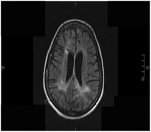 Figure 6: Brain MRI 30 months after treatment (April 2008), showing progressive periventricular white matter hyperintensities.