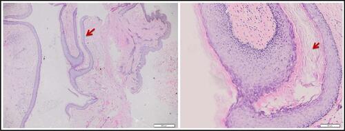 Figure 2 Histopathological findings (H&E staining, 20x and 100x). A cyst containing keratin and lined by wall of stratified squamous epithelium (red arrows).