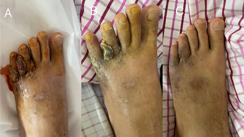 Figure 5 Changes in left foot Kaposi sarcoma after nab-paclitaxel chemotherapy, 1 cycle (A), 2 cycles (B), 3 cycles (C).