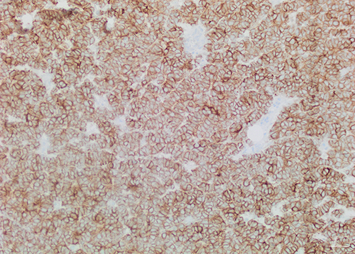 Figure 4 Tumor cells show diffuse positive staining for CD56. (Immunohistochemical stain, original magnification x20).