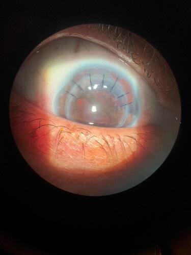 Figure 3 Slit lamp picture of the eye for the fourth case one week post-operatively showing seven 10/0 nylon stitches securing the area of donor-host junction dehiscence superiorly and a large iridodialysis superiorly and superionasally.