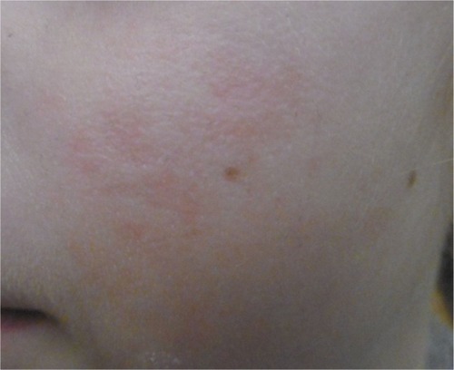 Figure 13 Recovery after 4 weeks of tested topical cream.