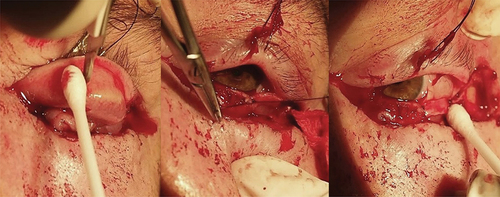 Figure 3. Taking a donor tarsus from an upper eyelid and suturing it to the healthy tarsus medially and to the periosteal band temporally.