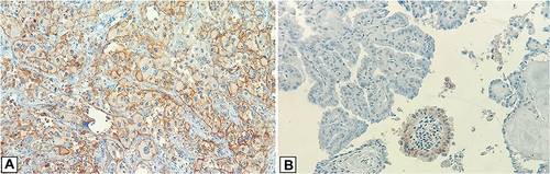 Figure 1 Immunohistochemical PD-L1 expression in TC samples using a mouse monoclonal anti-PD-L1 antibody (clone 22C3) (A) PD-L1 expression in this TC showed positive linear membrane staining, from weak to strong intensity (TPS ≥90%). (B) PD-L1 expression in this TC showed negative in many tumour cells and positive linear membrane staining only in some tumour cells (TPS 5.57%).