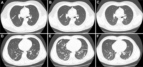Figure 2 Representative chest CT images of two confirmed COVID-19 patients. A 34-years-old male with mild COVID-19. (A) Chest CT images showing right lung small patchy shadows on admission. (B) The chest imaging alleviated on the third day after admission. (C) Chest CT images complete remission 7 days after admission. A 30-years-old male with moderate COVID-19. (D) Chest CT images showing bilateral ground-glass opacity and patchy shadows on admission. (E) The chest imaging was aggravated, accompanied by vascular shadow and bronchiectasis in the focus on the third day after admission. (F) Chest CT images showing bilateral ground-glass opacity and patchy shadows was improved and the inflammatory exudation was absorbed 20 days after admission. White arrows showed the imaging lesion on chest CT.