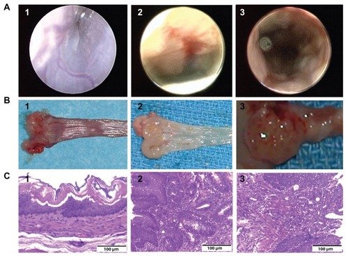 Figure 1 Endoscopic view, gross anatomy, and histology. (A) Endoscopic view of the esophageal epithelium. (A1) Normal esophageal epithelium; (A2) suspicious glandular epithelium appearing red-colored in the mucosa of the esophagoduodenal anastomosis, which was subsequently demonstrated to be Barrett’s metaplasia by histology; and (A3) suspicious glandular epithelium, which was later demonstrated to be esophageal adenocarcinoma by histology. (B) Gross anatomy. (B1) Normal esophageal epithelium; (B2) polypoid folders caused by esophagoduodenal anastomosis, with red mucosal patch in the esophageal epithelium; and (B3) tumor growing in the esophagoduodenal anastomotic site. (C) Histology of esophageal epithelium. (C1) Normal esophageal epithelium; (C2) Barrett’s metaplasia; and (C3) esophageal adenocarcinoma.
