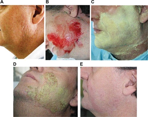 Figure 5 Patient with pike acne scars on left and right face sides (A) treated with double anterior chemabrasion. The patient undergoes a total of two sessions of anterior chemoabrasions with a 1-year interval, for personal reasons. (B) End point of second abrasion. (C) Application of bismuth subgallate. (D) At day 2, surprisingly, the skin is already in the advanced healing phase. There is no peripheral inflammation (post-peel mask action), and the healing looks to be perfectly sane. (E) At day 7, a thick coat of Vaseline will allow the crust to be easily removed without traction. The skin already appears reepithelized.