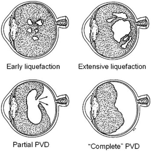 Figure 6. Schematic representation of different stages of posterior vitreous detachment in aged individuals. Reprinted by permission from (Springer), Eye,Citation19 Adult vitreous structure and postnatal changes. Le Goff MM, Bishop PN. Eye (2008) 22.