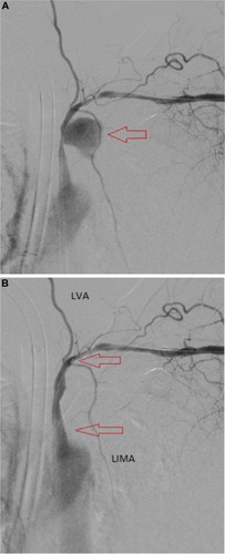 Figure 2 Perioperative angiograms. Arrows indicate (A) aneurysmal bag and (B) covered stent.