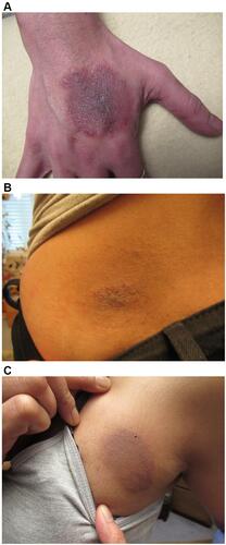Figure 2 (A–C) Expanding annular rashes on the patient’s hands, back and leg, with a raised, advancing, erythematous border consistent with secondary erythema migrans (EM) rashes.