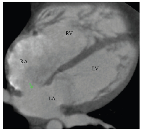 Figure 2 Cardiac computed tomography showing the large secundum atrial septal defect (green arrow) as well as the dilated right atrium (RA) and right ventricle (RV); LA (left atrium), LV (left ventricle).