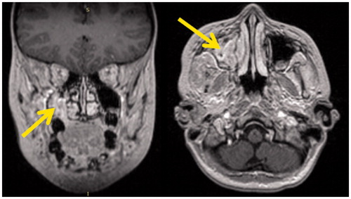 Figure 4. MRI showing right maxillary sinus mass.