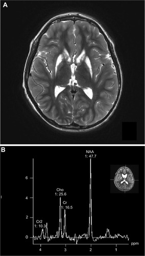 Figure 1 Axial MRI scan (A) and MRS spectrum (B) of a 9-year old boy with Leigh syndrome due to a mutation in the mtDNA.