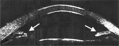 Figure 3 Ultrasound biomicroscopy image using the Humphrey-Zeiss model 840 (San Leandro, CA, USA [50 MHz]) showing an eye with aniridia.
