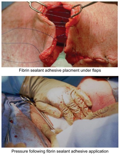 Figure 3 Use of fibrin sealant to attach skin flaps to underlying tissue at the time of neck dissection (top portion) and placement of gentle pressure during adhesive polymerization (bottom portion).Modified and used with permission of Peoples Medical Publishing House – USA (PMPH-USA) from Spotnitz WD, Burks SG, Prabhu R. Fibrin based adhesives and hemostatic agents. In: James V. Quinn, editor. Tissue Adhesives in Clinical Medicine, 2nd Edition. BC Decker; 2005: 94 (Figures 4–6).Citation45