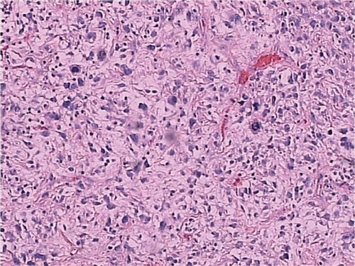 Figure 1 Hematoxylin and eosin staining of a tumor section (x200).