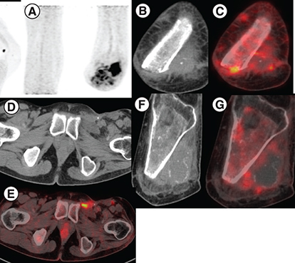 Figure 3. PET Scan imaging showing radiographic findings after treatment with tazemetostat.(A) MIP image showing focal increased tracer uptake in the left inguinal region and in the left knee joint region. (B & C) Previously seen cutaneous nodules in baseline image show resolution in size and metabolic activity in the present study. (D & E) Ulcerated subcentimetric left inguinal lymph nodes on CT showing increased FDG uptake on fused PET-CT scan. (F & G) Sclerosis in left tibia showing decreased FDG uptake compared with previous scan with overall findings suggest partial resolution of the disease following therapy.CT: Computed tomography; MIP: Maximum intensity projection.