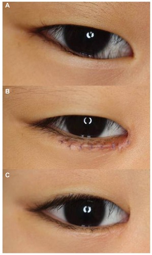 Figure 4 Hotz fishtail case. (A) A 6-year-old boy who had a typical epicanthal fold with inverted cilia (epiblepharon) prior to surgery. (B) He underwent the combined Hotz procedure and fish-tail resection. Two weeks after surgery, the 7-0 Vicryl sutures still remained. An L-shaped incision is recognized by the sutures. His inverted cilia were corrected completely. (C) Six months later his medial canthus angle was still open and the cilia were more everted than in the Hotz alone case.