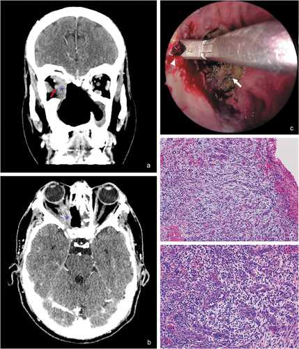 Figure 2. (a,b) Computed tomography scan ((a) coronal plane, (b) axial plane) shows a large midline bony defect and an infiltrating mass (blue asterisk) extending into the right inferomedial orbit and apex. It is possible to appreciate the proximity of the soft-tissue mass to the right optic nerve (red arrow). (c) Endoscopic transnasal approach for biopsy using image-guided neuro-navigation system that exhibits friable granulation tissue at the right medial orbital wall (white arrowhead), and patchy areas of necrotic tissue (white arrow). (d) Partially necrotized tissue, composed primarily of granulation tissue (hematoxylin-eosin, 100x). (e) Small vessels and fibroblastic proliferation with prominent lymphocytic and neutrophilic inflammation (hematoxylin-eosin, 200x).