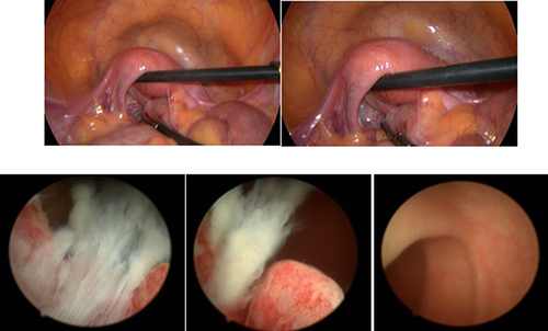 Figure 2 Diagnostic laparoscopy and diagnostic hysteroscopy.