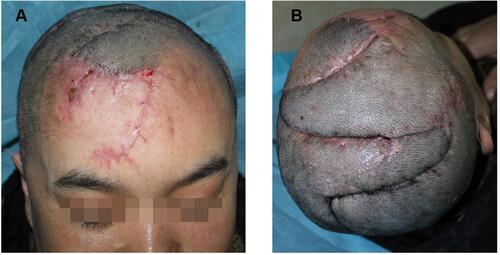 Figure 5 A light red striped scar can be seen on the forehead (A) and top of the head (B) after surgery.