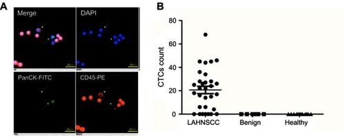 Figure 1 CTC detection in LAHNSCC patients. (A) Immunofluorescent staining of CTCs detected by the CytoSorter® system. CTCs are identified as DAPI (blue) positive, PanCK (FITC, green)-positive, and CD45 (PE, orange)-negative cells. CTCs are indicated by the yellow arrow, while WBCs are marked by white arrows. (B) CTC enumeration differentiated LAHNSCC patients from healthy/patients with benign tumors (P<0.0001).Abbreviations: LAHNSCC, locally advanced head and neck squamous cell carcinoma; CTC, circulating tumor cells.