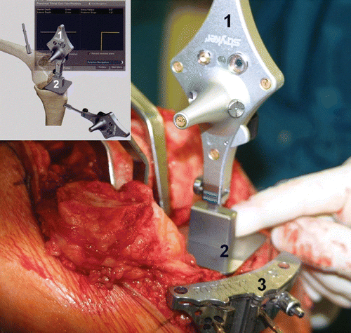 Figure 4. Conventional cutting block for the tibial cut after navigated positioning. 1 = tracker; 2 = resection plane probe; 3 = resection block (NexGen®). [Color version available online.]