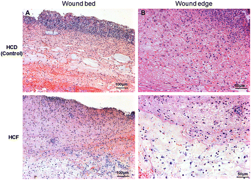 Fig. 3. Histologic analysis of the wound edge and the wound bed.Note: Periwound skin and granulation tissue samples were collected on day 3 and used to assess histologic analysis. Hematoxylin and eosin staining showed severe inflammation and edema in the wound edge (A) and the wound bed (B) of the HCD group, compared with the HCF group. Magnification in (A) × 10, (B) × 20.