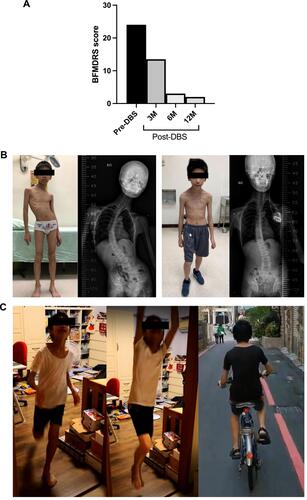 Figure 2 The clinical improvement of the DYT6 dystonia patient after effective bilateral pallidal stimulation. (A) The BFMDRS score changes at baseline and 3-, 6-, and 12-months after GPi-DBS. (B) Significant improvement in severe scoliosis of the patient and findings of spine x-rays pre-operatively and at 6-months after GPi-DBS. (C) Photos showing his daily physical activity nearly normal state after successful treatment of scoliosis and dystonia at 12 months after GPi-DBS.