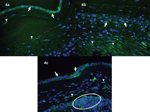 Figure 4.  Immunofluorescence images of HMGB1 immunoreactivity in the chorioamniotic membranes. (a) Chorioamniotic membranes obtained from an uncomplicated pregnant woman who delivered at term. HMGB1 immunoreactivity (green) is evident in the amnion epithelial cells (arrows) and mesenchymal cells of the chorioamniotic connective tissue (arrowheads). ×400. (b) Chorioamniotic membranes obtained from a different case of normal term delivery. Scattered HMGB immunoreactivity (green) is observed in the chorionic trophoblasts (arrows) and decidual stromal cells (arrowheads). ×400. (c) Chorioamniotic membranes obtained from a patient who delivered preterm with acute chorioamnionitis and funisitis. Distinct immunoreactivity (green) is detected in the amnion epithelial cells (arrows), myofibroblasts of chorioamniotic connective tissue (arrowheads), and infiltrating neutrophils (circle). ×400. DAPI (blue) was used to stain nuclei.