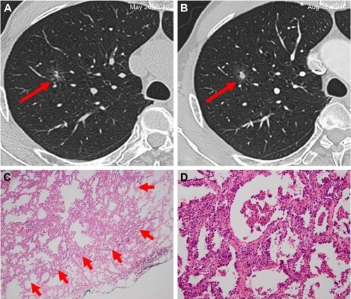 Figure 3 Invasive adenocarcinoma in a 66-year-old man.