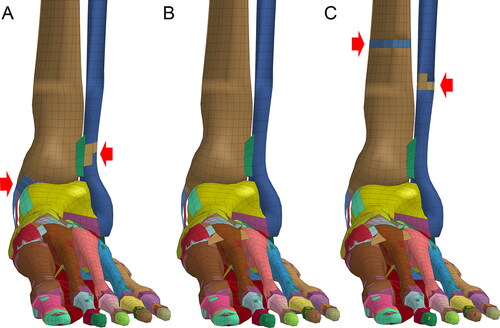 Figure 6. Ankle fractures formed by posterior-anterior (P-A) impacts on the ankle. (A) Impact at a speed of 10 m/s caused lateral condyle fracture and avulsion fractures of the medial condyle. (B) Impact at a speed of 15 m/s did not cause fractures. (C) Impact at a speed of 20 m/s caused tibia and fibula fractures at the impact points. (Red arrow indicates the fracture site where elements are colored differently from the surrounding area).