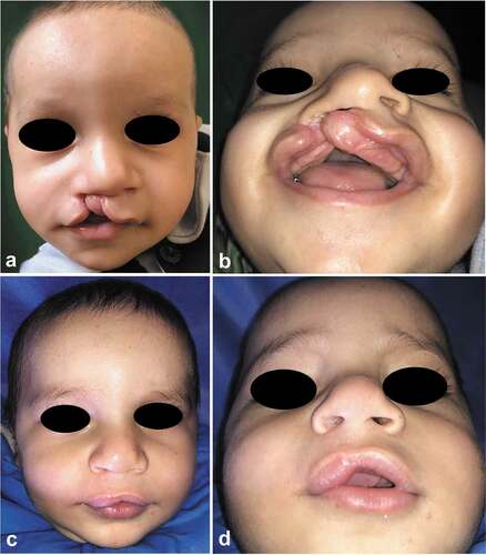 Figure 10. A case of Fisher’s group; 6-month-old male, with right-sided unilateral complete cleft lip. (a and b) Preoperative frontal and submental views and (c and d) 5 months’ postoperative frontal and submental views