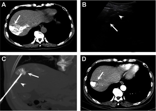 Figure 1 A 66-year-old male patient who was diagnosed with moderately differentiated HCC according to the pathologic examination received combined US/CT-guided RFA after TACE treatment. (A) A CT scan which was performed after TACE treatment showed the HCC lesion with intense lipiodol accumulation (arrow). (B) The HCC lesion (arrow) was incompletely visible on US because of the obstruction of air in the lung. The electrode needle (arrowhead) was inserted into the site closest to the tumor under US guidance. (C) A three-dimensional image of CT scan was used to observe the position of the probe (arrow: tumor; arrowhead: multiple electrode needle). (D) A contrast-enhanced CT scan, that was performed seven months after the combined US/CT-guided RFA procedure, showed the ablated tumor (arrow) with intense lipiodol accumulation and no local recurrence.Abbreviations: CT, computed tomography; US, ultrasound; RFA, radiofrequency ablation; TACE, transarterial chemoembolization; HCC, hepatocellular carcinoma.