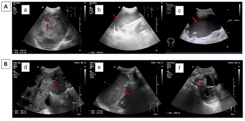 Figure 2. Abdominal ultrasound showed reduction in hepatosplenomegaly and ascites after receiving pomalidomide based therapy. (A: At diagonisis of EMD; a: Several hypoechoic areas, largest 26*22 mm in size, were seen in liver; b: Splenomegaly, 125*51 mm; c: a dark area of fluid was seen in the abdomen, approximately 87 mm deep. B: After receiving pomalidomide based therapy for three months; d: Several hypoechoic intraheptic areas were smaller than before, the largest one was 18*16 mm; e: Splenomegaly was smaller than before, 113*48 mm; f: inferior abdominal fluid dark area was 65 mm in depth).