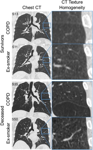 Figure 3. Chest CT for representative surviving and deceased ex-smokers with and without COPD. Coronal center-slice of chest CT and the corresponding qualitative CT texture heterogeneity. Top panel: A 63 yo male ex-smoker with COPD: FEV1=72% pred, FEV1/FVC = 50, BMI =27 kg/m2, DLCO=79%pred, ADC = 0.38 cm2/s, VDP = 10%, RA950=10.8%, GLCM-Imc2=.77, Wavelet-HH-GLDM-DV=.812; And a 66 yo female ex-smoker: FEV1=80%pred, FEV1/FVC = 76, BMI =36 kg/m2, DLCO=80%pred, ADC = 0.24 cm2/s, VDP = 5.4%, RA950=2.3%, GLCM-Imc2=.76, Wavelet-HH-GLDM-DV=.766; Bottom panel: A 78 yo male ex-smoker with COPD that died: FEV1=38%pred, FEV1/FVC = 39, BMI =20 kg/m2, DLCO=30%pred, ADC = 0.55 cm2/s, VDP = 28%, RA950=24.9%, GLCM-Imc2=.84, Wavelet-HH-GLDM-DV = 1.14; And a 64 yo female ex-smoker that died: FEV1=111%pred, FEV1/FVC = 82, BMI = 36 kg/m2, DLCO=68%pred, ADC = 0.26 cm2/s, VDP = 4.5%, RA950=1.2%, GLCM-Imc2=.82, Wavelet-HH-GLDM-DV = 1.02.
