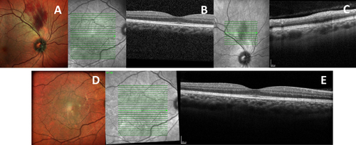 Figure 4 Case Report 4: At presentation: (A) Retinography with superior temporal periarchal hemorrhage; (B and C) No macular edema on Macular SD-OCT but thickening of the inner layers of the retina at the site of bleeding. At 1st year of symptoms: (D) Retinography without hemorrhage; (E) Macular SD-OCT without edema.