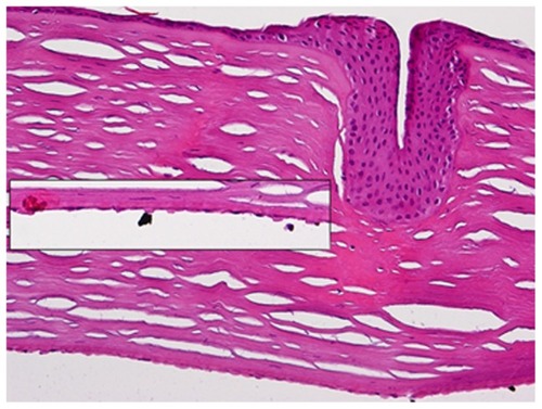 Figure 2 Hematoxylin and eosin stain at 40× magnification of Case 1 left cornea, showing RK incisions with an epithelial plug and a thickened Descemet’s membrane with guttata (insert).