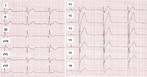 Figure 8. ECG manifestation of short QT syndrome. A short QT interval (QTc 292 ms) with high, peaked T waves in right precordial leads. This patient had ventricular fibrillation at the age of 18 and was successfully resuscitated. Later on the patient received an ICD. Paper speed 50 mm/s, gain 10 mm/mV.