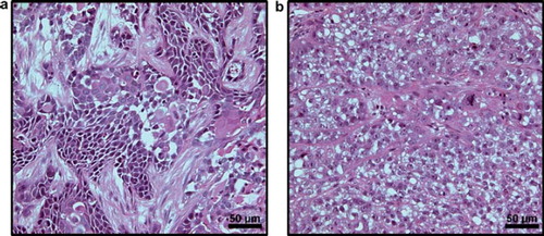 Figure 1. Histological preparations of a well-differentiated CK-160 (a) and a poorly differentiated TS-415 (b) tumor stained with hematoxylin and eosin.